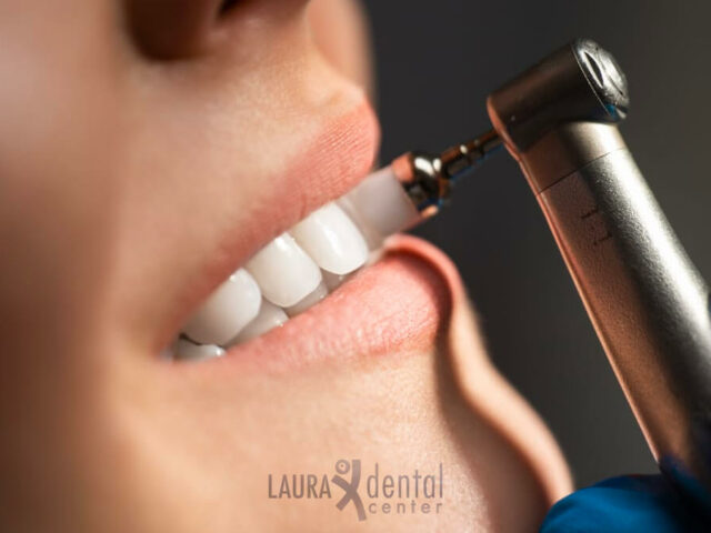 How to Whiten Veneer Teeth