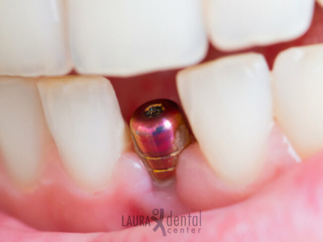 The Benefits of Mini Dental Implants