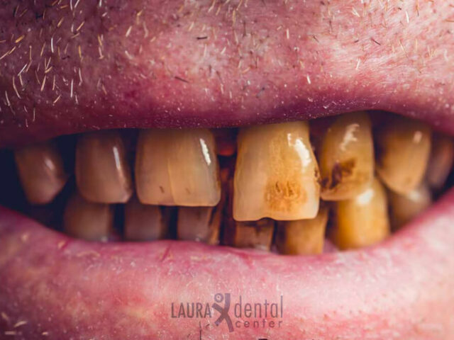 The Dangers of Tobacco Use Impact on Oral Health