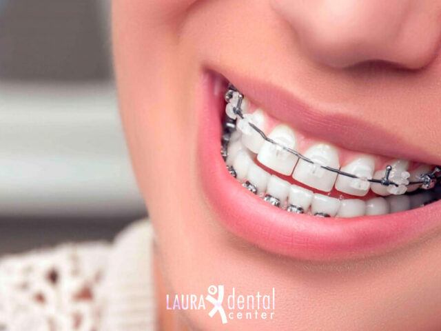 Getting Rid of Plaque on Teeth with Braces