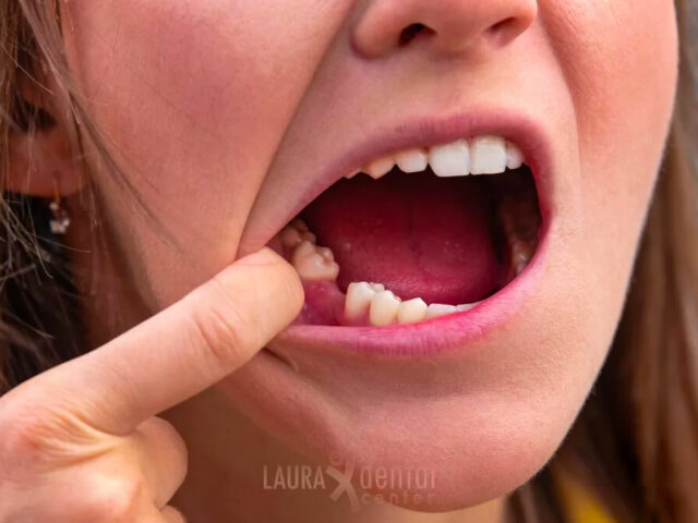 When Can You Eat Solid Food After Tooth Extraction?