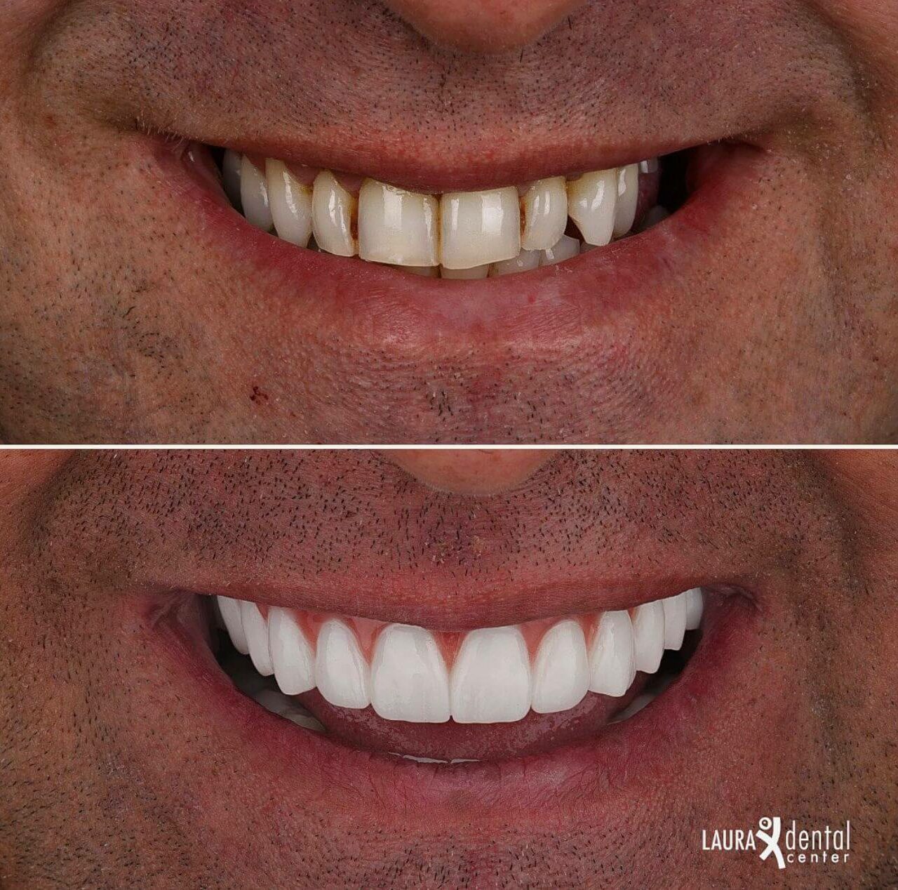https://lauradentalcenter.com/storage/2024/12/all-on-6-implant-3-1280x1268.jpeg