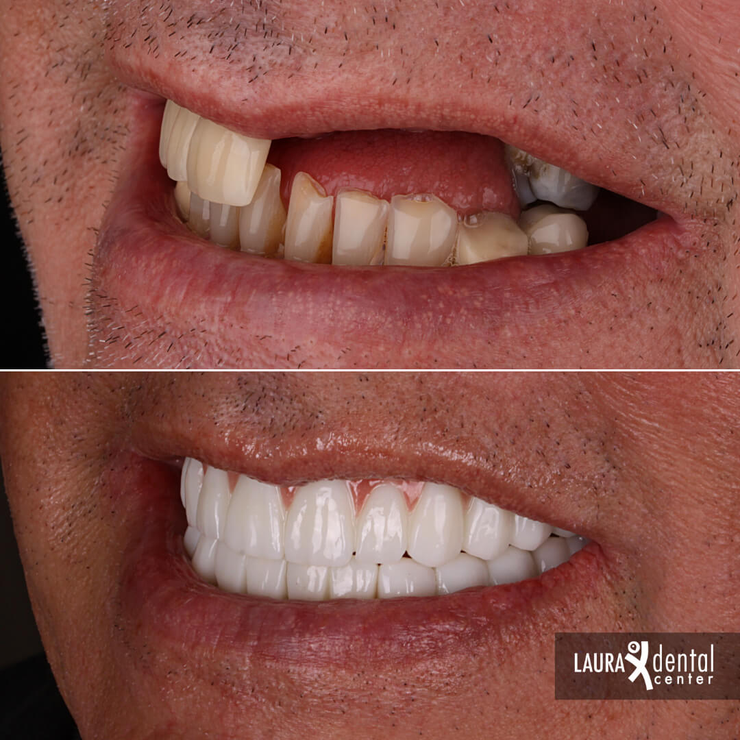 https://lauradentalcenter.com/storage/2024/12/all-on-6-implant-7.jpg