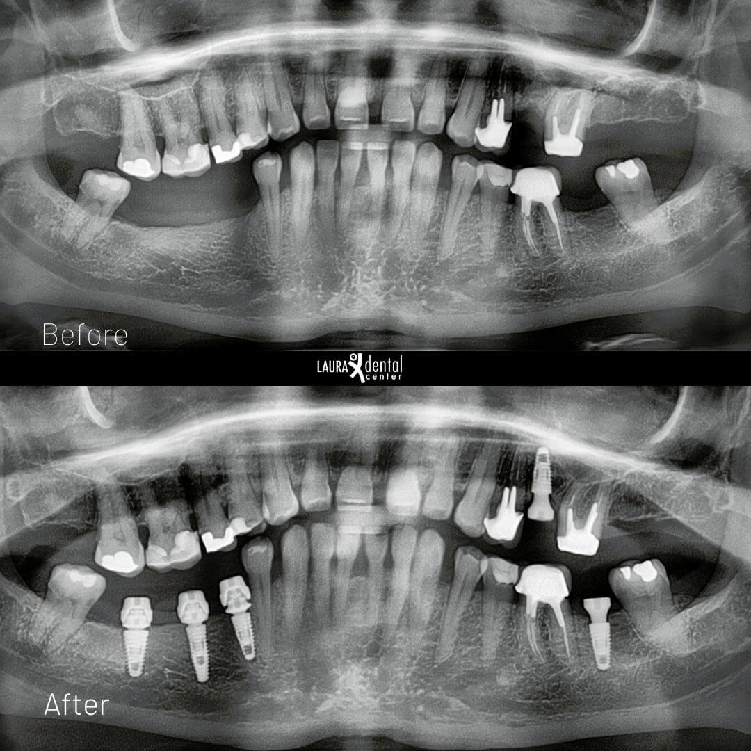 https://lauradentalcenter.com/storage/2024/12/dental-implant1.jpg