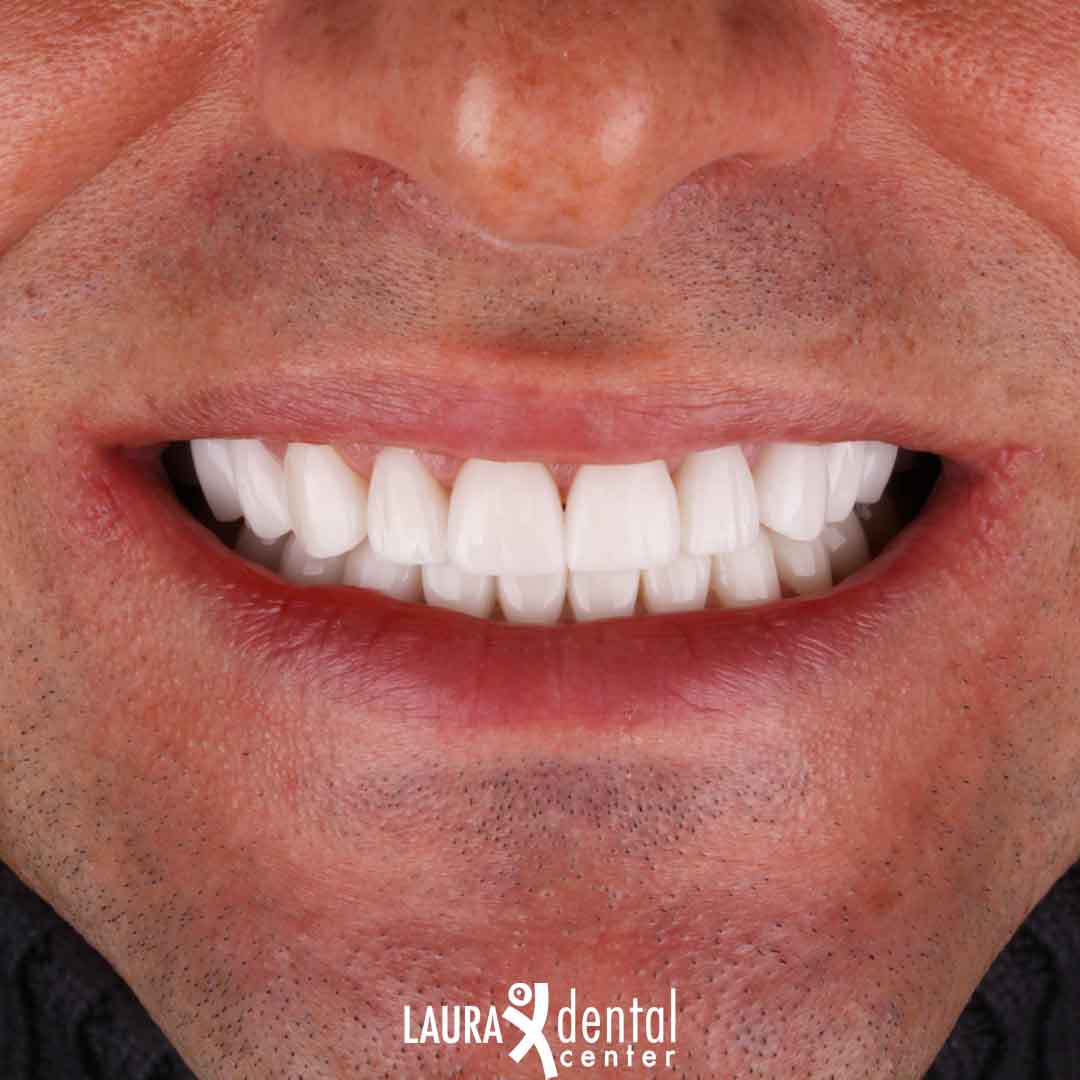 https://lauradentalcenter.com/storage/2025/01/emax-veneers-antalya-turkey.jpg