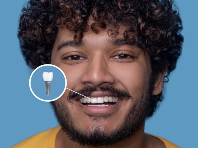 All-on-4 vs All-on-6 Procedure