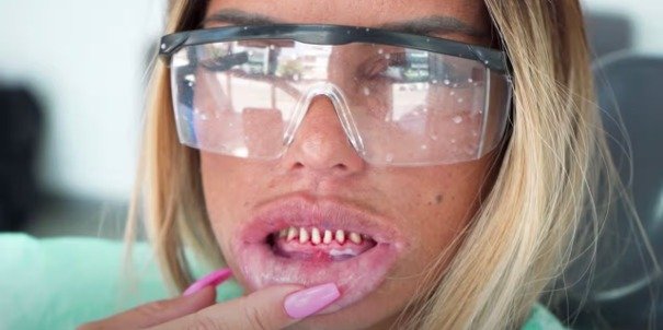 Teeth shaved down for full dental crowns as part of the Turkey teeth trend