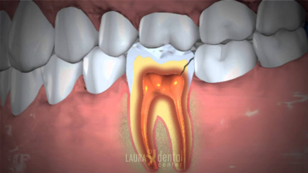 how-long-until-a-tooth-infection-kills-you-microbioz-india